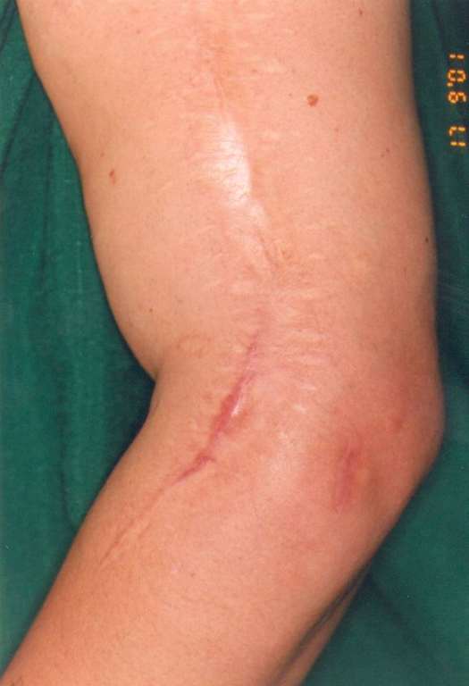 Osteomyelitis