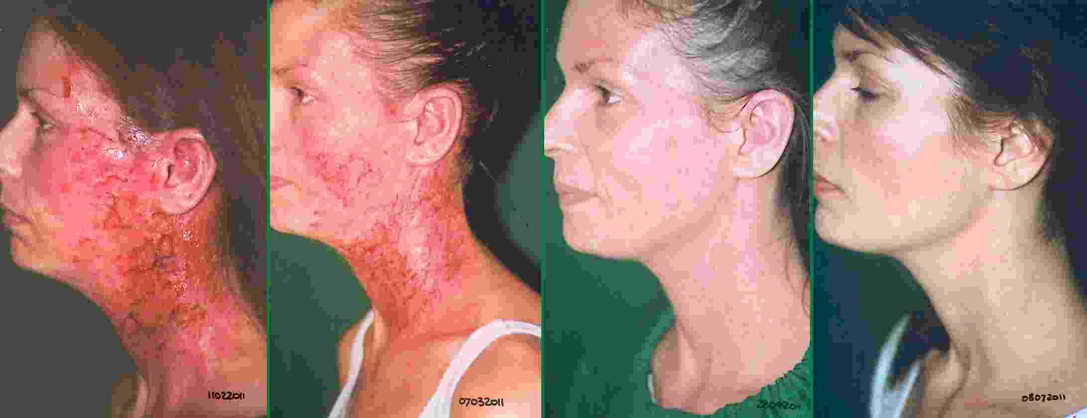 eczema